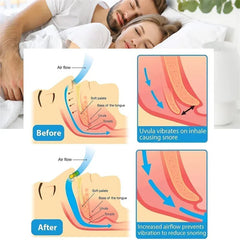 Anti-Snoring Gadget